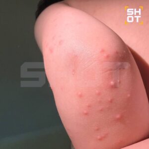 Полуторагодовалый ребёнок покрылся жуткой сыпью на отдыхе в Таиланде. Маленькие прыщики появились у него даже на горле. Родители уверяют, что заболеванием страдают десятки детей, находящихся в том же отеле. По данным SHOT, изначально у малыша, который вместе с родителями был в отеле Robinzon в курортном городе Кхао-Лак, поднялась сильная температура до 38,7 градуса. На следующий день она выросла ещё сильнее, ребёнок постоянно плакал. По словам мамы, мальчика повезли в больницу, где врачи диагностировали бронхит и тонзиллит, а также назначили антибиотик. От него малышу стало хуже: температура поднялась до 39,6 градуса, а по всему телу и даже горлу пошла сыпь. Родители мальчика говорят, что их сын не единственный, кто подхватил заболевание в отеле. По их словам, похожие симптомы наблюдаются ещё у десятка малышей. Некоторые также жалуются на рвоту. Взрослые подозревают, что их дети заразились вирусом Коксаки. 🚨 Ситуация накаляется, и родители требуют ответов от администрации отеля.. Таиланд, Кхао-Лак, вирус Коксаки, детское здоровье, отель Robinzon