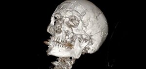 Подмосковные хирурги совершили настоящее чудо, восстановив лицо мужчины, который упал со снегохода. У пациента был диагностирован многооскольчатый перелом нижней зоны лица и переломы лобной кости. Операция, которая длилась почти семь часов, стала настоящим испытанием для врачей. Сложность заключалась не только в масштабе повреждений, но и в необходимости восстановить функциональность и эстетику лица. Хирурги справились блестяще, используя современные технологии и методы. Пациент уже выписан из больницы, но его ждет длительный курс реабилитации. Этот случай еще раз подтверждает, что российская медицина способна на невозможное. 💪 Источник: Подробнее. Подмосковье, хирургия, восстановление лица, медицина, снегоход