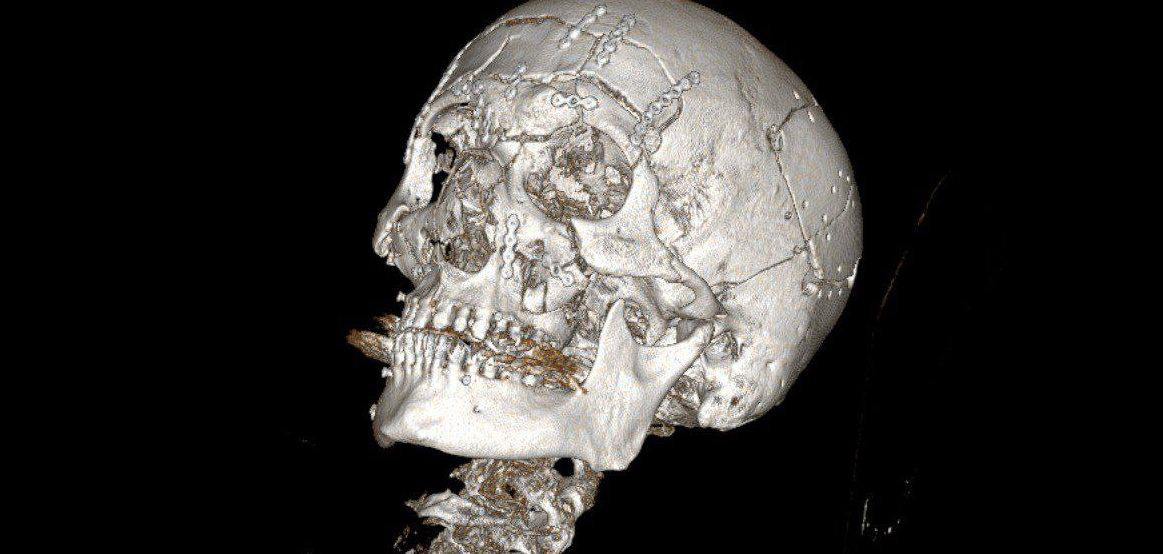 Подмосковные хирурги совершили настоящее чудо, восстановив лицо мужчины, который упал со снегохода. У пациента был диагностирован многооскольчатый перелом нижней зоны лица и переломы лобной кости. Операция, которая длилась почти семь часов, стала настоящим испытанием для врачей. Сложность заключалась не только в масштабе повреждений, но и в необходимости восстановить функциональность и эстетику лица. Хирурги справились блестяще, используя современные технологии и методы. Пациент уже выписан из больницы, но его ждет длительный курс реабилитации. Этот случай еще раз подтверждает, что российская медицина способна на невозможное. 💪 Источник: Подробнее. Подмосковье, хирургия, восстановление лица, медицина, снегоход