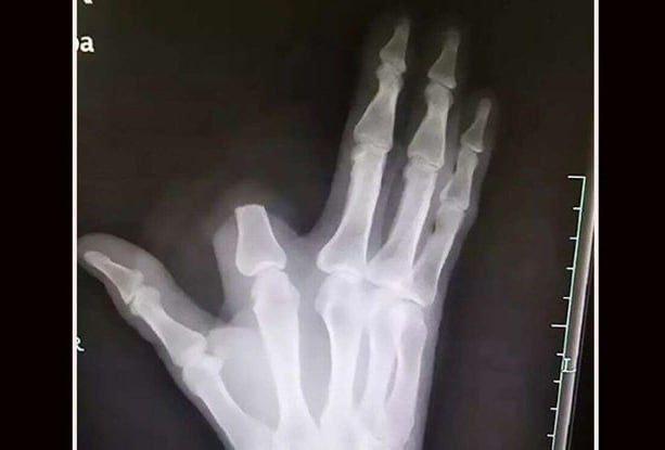 В провинции Чжэцзян, Китай, 60-летний фермер, работая в поле, был укушен змеёй. В панике мужчина решил, что змея ядовита, и самостоятельно ампутировал себе указательный палец подручными средствами. После процедуры фермер перевязал рану и самостоятельно добрался до больницы. Однако врачи сообщили, что змея была неядовитой, и ампутация не требовалась. Палец спасти не удалось, так как он остался на месте происшествия. Мужчина выжил, но его поступок стал примером того, как паника может привести к необратимым последствиям. Врачи подчеркнули, что в подобных ситуациях важно сохранять спокойствие и незамедлительно обращаться за медицинской помощью.. Китай, Чжэцзян, фермер, змея, ампутация