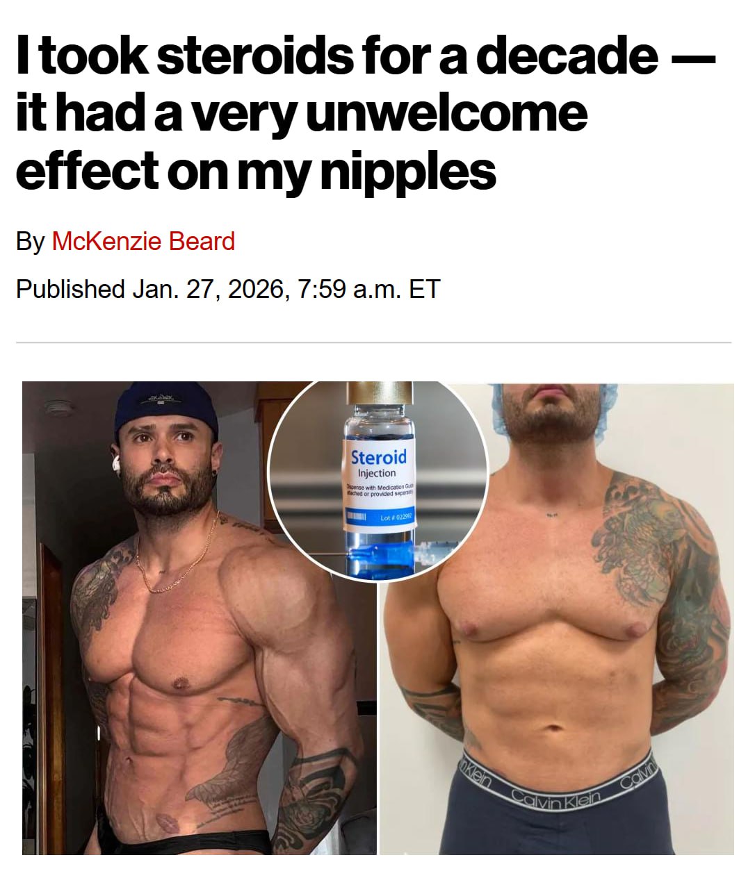 Кристиан Буэно, 33-летний бодибилдер, десятилетиями гнался за идеальным телом. Но цена оказалась слишком высокой. 💉 За 10 лет употребления анаболических стероидов его организм дал сбой. Грудные железы разрослись до невероятных размеров, а соски обвисли, как уши спаниеля. 🐶 После отказа от стероидов естественная выработка тестостерона упала до уровня 80-летнего старика. На восстановление ушло два года, но проблема с грудью осталась. Парню пришлось ложиться под нож ради операции по уменьшению. 🔪 История Буэно — это не просто скандал, а жесткое напоминание: за каждым мускулом может скрываться цена, которую не каждый готов заплатить. 💔. Кристиан Буэно, бодибилдинг, стероиды, здоровье, операция