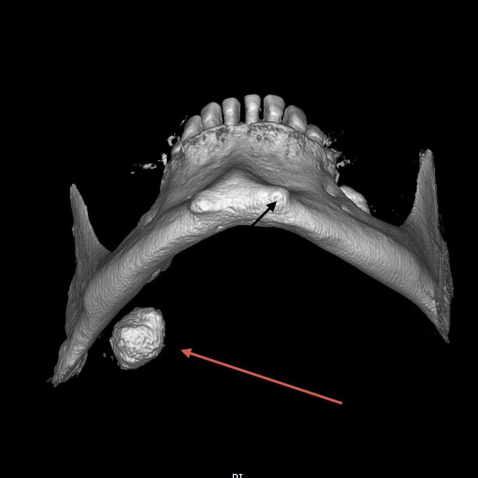 Владивосток, Краевая больница №2. Здесь врачи провели операцию, которая впечатлит даже самых стойких. У пациента удалили слюнной камень диаметром более 2 см. Да, вы не ослышались — больше двух сантиметров! 💎 Мужчина терпел эту проблему целых 17 лет. К врачам обратился только тогда, когда камень начал реально мешать жить. Слюнно-каменная болезнь — штука редкая, но, как видите, может доставить серьезные неудобства. Что это вообще такое? Слюнные камни образуются в протоках слюнных желез. Они могут блокировать отток слюны, вызывая боль и воспаление. Обычно их размер не превышает нескольких миллиметров, но тут случай исключительный. Операция прошла успешно, мужчина уже на пути к выздоровлению. Но, друзья, не тяните с такими вещами. Здоровье — это не шутка. 🚑. Владивосток, Краевая больница №2, слюнно-каменная болезнь, медицина, здоровье