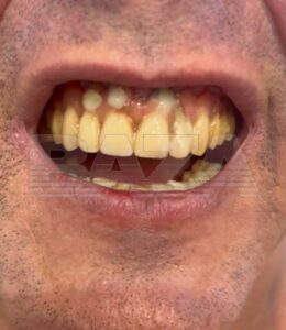 Чемпион мира и Европы по жиму лёжа Андрей Попов подал иск против московской клиники «Этастом» из-за некачественного лечения зубов. Спортсмен обратился в клинику год назад, где ему предложили план лечения стоимостью 310 тысяч рублей, включавший удаление 11 зубов и установку 6 имплантов с постоянным протезом. После процедур Попов столкнулся с постоянной болью и невозможностью носить временный протез. Лечащий врач пытался исправить ситуацию, но проблема оказалась в шатающихся имплантах. Дополнительно спортсмен потратил ещё 53 тысячи рублей на терапию, которая не принесла результата. Обратившись в другую клинику, Попов узнал, что протезирование выполнено крайне плохо и требует полного перелечивания. Руководство «Этастома» отказалось возвращать средства и предоставить копию медицинской карты. Теперь спортсмен требует компенсацию в размере более полумиллиона рублей за двойное лечение, моральный вред и экспертизу. К юристу Попова также обратились другие пострадавшие, которые планируют добиваться возмещения ущерба от клиники.. Андрей Попов, Этастом, суд, стоматология, Москва