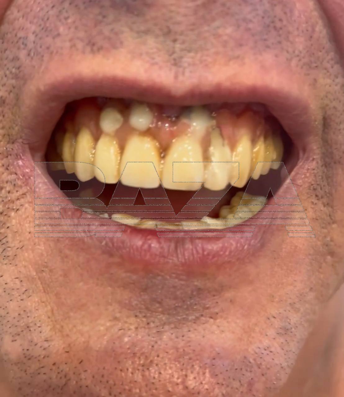 Чемпион мира и Европы по жиму лёжа Андрей Попов подал иск против московской клиники «Этастом» из-за некачественного лечения зубов. Спортсмен обратился в клинику год назад, где ему предложили план лечения стоимостью 310 тысяч рублей, включавший удаление 11 зубов и установку 6 имплантов с постоянным протезом. После процедур Попов столкнулся с постоянной болью и невозможностью носить временный протез. Лечащий врач пытался исправить ситуацию, но проблема оказалась в шатающихся имплантах. Дополнительно спортсмен потратил ещё 53 тысячи рублей на терапию, которая не принесла результата. Обратившись в другую клинику, Попов узнал, что протезирование выполнено крайне плохо и требует полного перелечивания. Руководство «Этастома» отказалось возвращать средства и предоставить копию медицинской карты. Теперь спортсмен требует компенсацию в размере более полумиллиона рублей за двойное лечение, моральный вред и экспертизу. К юристу Попова также обратились другие пострадавшие, которые планируют добиваться возмещения ущерба от клиники.. Андрей Попов, Этастом, суд, стоматология, Москва