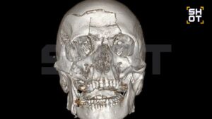 В подмосковном Жуковском произошёл тяжёлый несчастный случай, в результате которого 44-летний мужчина получил множественные травмы лица. По информации источника, он упал со снегохода, что привело к серьёзным повреждениям лобной кости, носовых пазух и челюсти. Для спасения жизни пострадавшего в Жуковской больнице была проведена сложная операция, которая длилась семь часов. В ходе вмешательства нейрохирурги удалили обломки лобной кости, а также заднюю стенку пазухи и слизистую оболочку. Просвет пазухи был заполнен аутокостной крошкой. Челюстно-лицевые хирурги восстановили повреждённые участки черепа, включая лоб, глазницы и обе челюсти. Для фиксации использовались титановые мини-пластины. После операции мужчина прошёл первичную реабилитацию и был выписан из больницы. Однако его ждёт длительный период восстановления.. Жуковский, снегоход, травмы лица, нейрохирургия, челюстно-лицевая хирургия