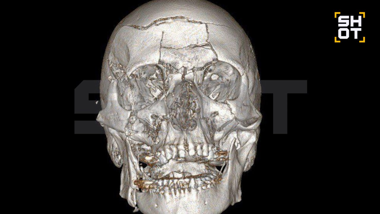В подмосковном Жуковском произошёл тяжёлый несчастный случай, в результате которого 44-летний мужчина получил множественные травмы лица. По информации источника, он упал со снегохода, что привело к серьёзным повреждениям лобной кости, носовых пазух и челюсти. Для спасения жизни пострадавшего в Жуковской больнице была проведена сложная операция, которая длилась семь часов. В ходе вмешательства нейрохирурги удалили обломки лобной кости, а также заднюю стенку пазухи и слизистую оболочку. Просвет пазухи был заполнен аутокостной крошкой. Челюстно-лицевые хирурги восстановили повреждённые участки черепа, включая лоб, глазницы и обе челюсти. Для фиксации использовались титановые мини-пластины. После операции мужчина прошёл первичную реабилитацию и был выписан из больницы. Однако его ждёт длительный период восстановления.. Жуковский, снегоход, травмы лица, нейрохирургия, челюстно-лицевая хирургия