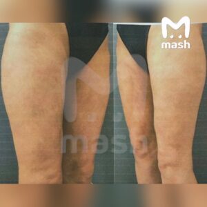 Жительница Краснодара столкнулась с серьезными осложнениями после процедуры липосакции ягодиц, проведенной в 2021 году. По данным источника, операция обошлась женщине в 70 тысяч рублей, что соответствовало рыночной цене на тот момент. Однако спустя полгода пациентка обнаружила деформацию ягодиц, появление гематом и уплотнений. Клиника первоначально признала ошибку и предложила повторную процедуру, но после выявления осложнений отказалась от дальнейшего лечения. Пациентке была выплачена компенсация в размере 300 тысяч рублей для проведения операции в другой клинике, специализирующейся на сложных случаях. Однако и там врачи отказались от вмешательства, ссылаясь на нарушение кровоснабжения. Независимая экспертиза установила, что хирург повредил кровеносные сосуды, что привело к некрозу тканей и инфаркту тазобедренной кости. Женщина подала иск в суд, требуя компенсацию в размере 4,8 млн рублей, включая затраты на лечение и моральный ущерб. Клиника, в свою очередь, обвиняет пациентку в мошенничестве, ссылаясь на подписанный ею отказ от претензий.. Краснодар, липосакция, суд, медицинские ошибки, компенсация