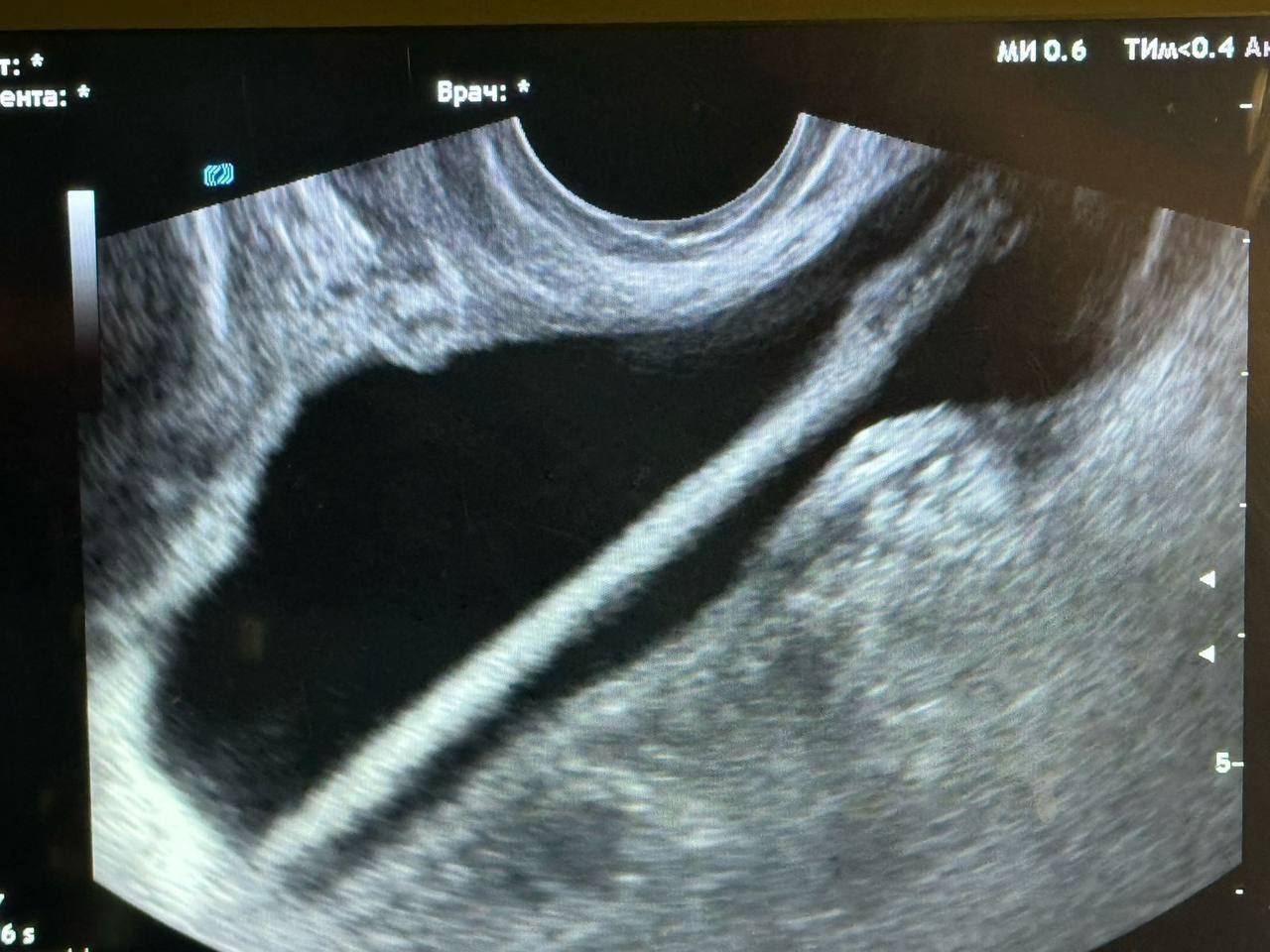 Косметический карандаш в мочевом пузыре: история одной пациентки. Красногорск, медицина, здоровье, происшествия, косметика