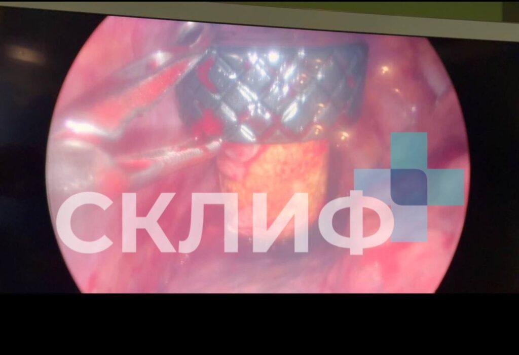 Хирурги извлекли пробку от коньяка из легких мужчины в НИИ Склифосовского. НИИ Склифосовского, хирургия, происшествия, здоровье, Москва