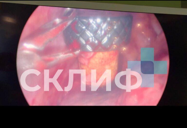 Хирурги извлекли пробку от коньяка из легких мужчины в НИИ Склифосовского. НИИ Склифосовского, хирургия, происшествия, здоровье, Москва