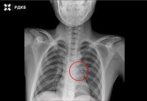 Московские хирурги спасли ребенка, вдохнувшего булавку 🚑. Москва, Хирургия, Дети, Калининград, Медицина