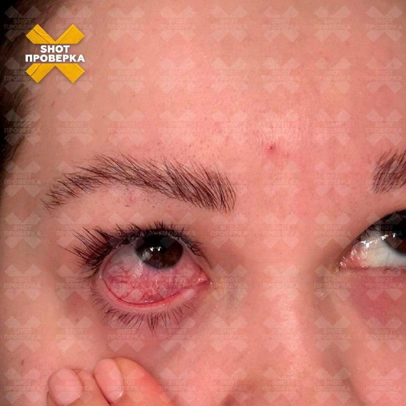 Москвичка получила химический ожог глаза после наращивания ресниц. Москва, Щёлковское шоссе, химический ожог, наращивание ресниц, Роспотребнадзор