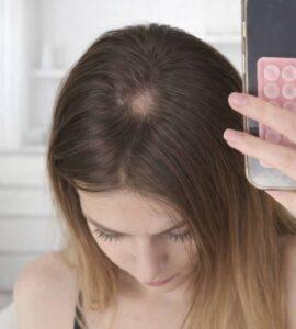 Москвичка подхватила микоз от шапки с маркетплейса 🧢. микоз, маркетплейс, здоровье, Москва, грибковая инфекция