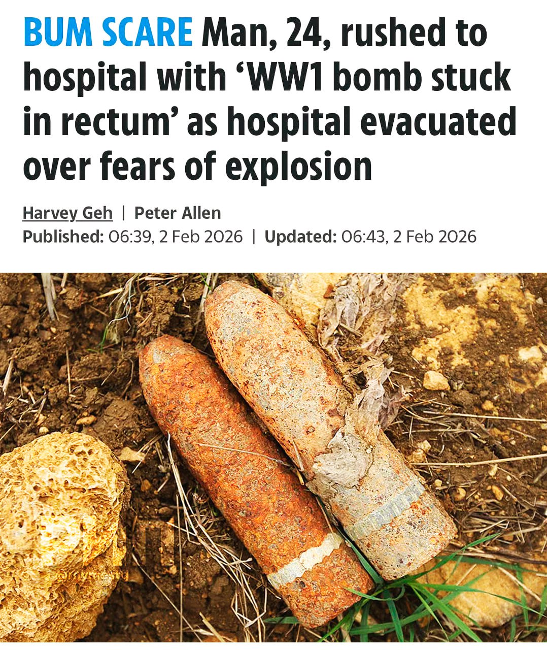 Во Франции произошёл необычный инцидент, связанный с обнаружением артиллерийского снаряда времен Первой мировой войны в теле пациента. 24-летний мужчина обратился в больницу с жалобами на сильную боль. Результаты рентгеновского обследования показали наличие 20-сантиметрового боеприпаса в его прямой кишке. Медикам пришлось экстренно эвакуировать пациентов и персонал, вызвать сапёров, а также оцепить прилегающую территорию. Пожарные службы были переведены в режим повышенной готовности. Теперь мужчине предстоит объяснить полиции, как и где он нашёл снаряд, а также причины его помещения внутрь тела. Это уже не первый подобный случай во Франции. В 2022 году в Тулоне аналогичный инцидент произошёл с 88-летним мужчиной. Власти продолжают расследование обстоятельств происшествия.. Франция, Происшествия, Медицина, Артиллерийский снаряд, Тулоне