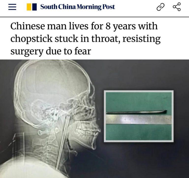 Мужчина 8 лет жил с палочкой в горле из-за страха перед врачами