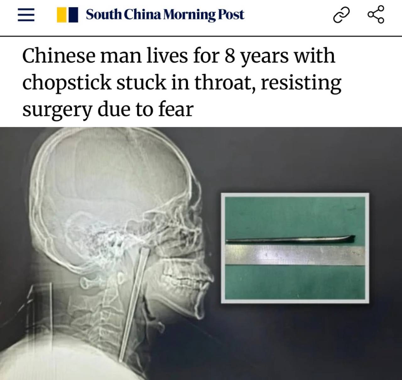 Мужчина 8 лет жил с палочкой в горле из-за страха перед врачами