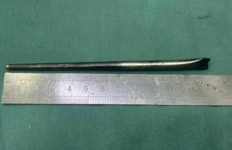 Мужчина 8 лет жил с палочкой в горле: невероятная история