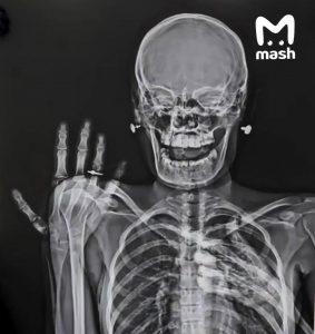 Рентген-кольца: новый тренд среди влюбленных медиков