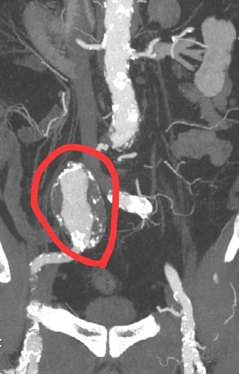 Уникальная операция в Раменской больнице спасла пациента