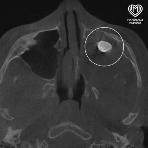 В носу подростка нашли зуб: уникальный случай в Москве