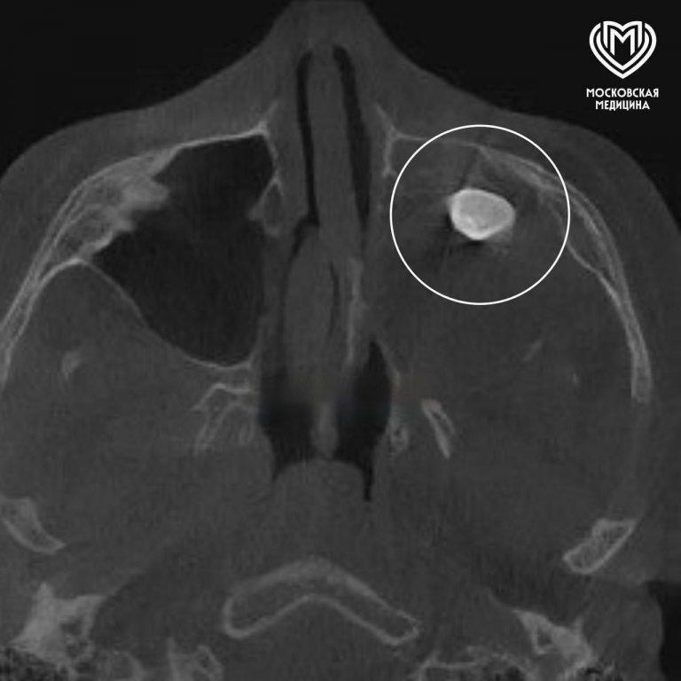 В носу подростка нашли зуб: уникальный случай в Москве