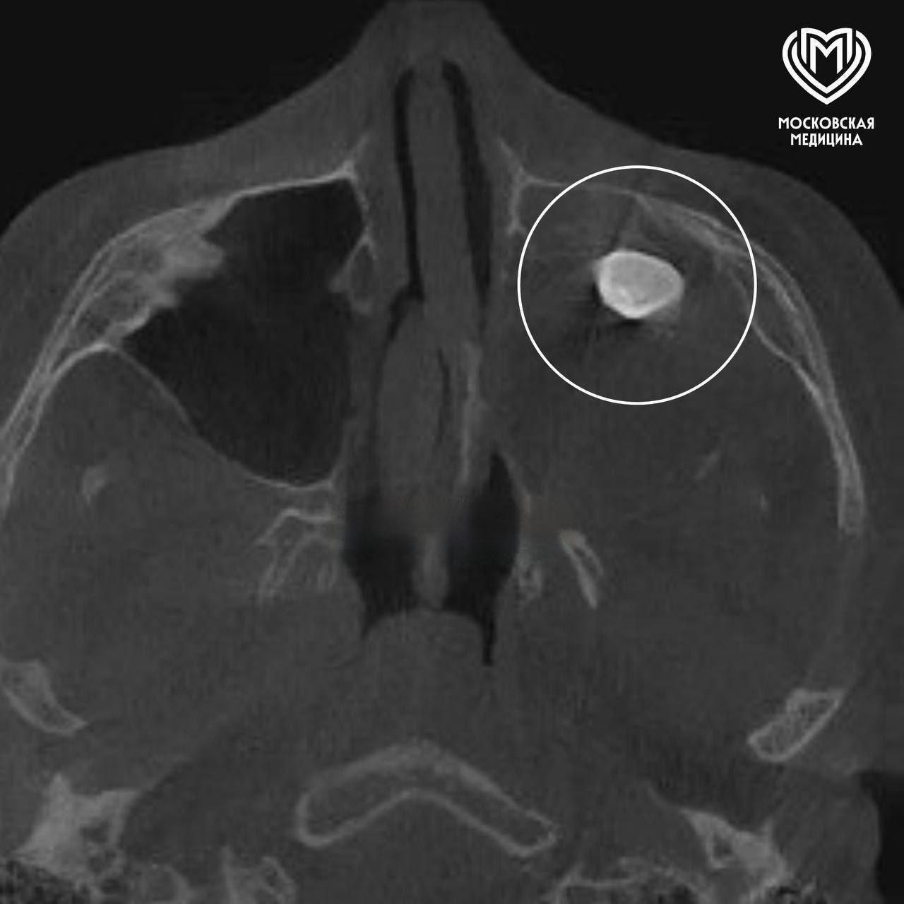 В носу подростка нашли зуб: уникальный случай в Москве