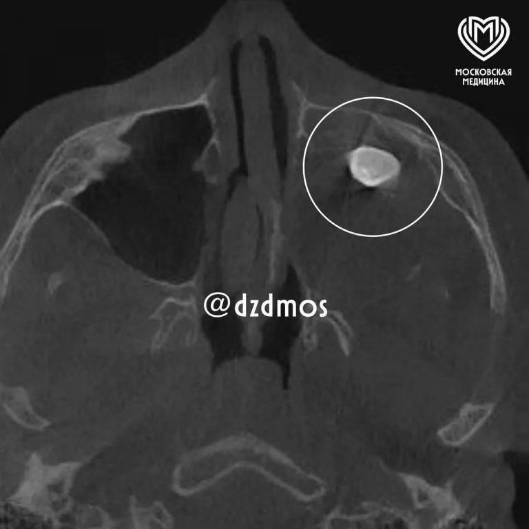 Зуб в носу у подростка: врачи обнаружили редкую аномалию