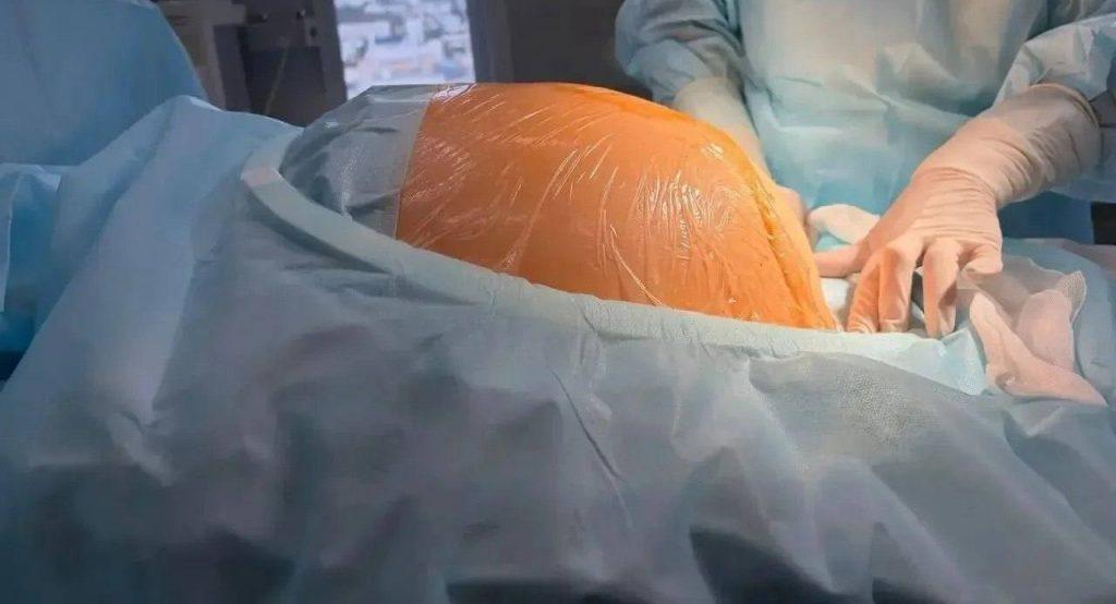 Хирурги спасли пациентку: извлечена гигантская опухоль 🏥⚡ — из живота пациентки удалили опухоль 10 кг