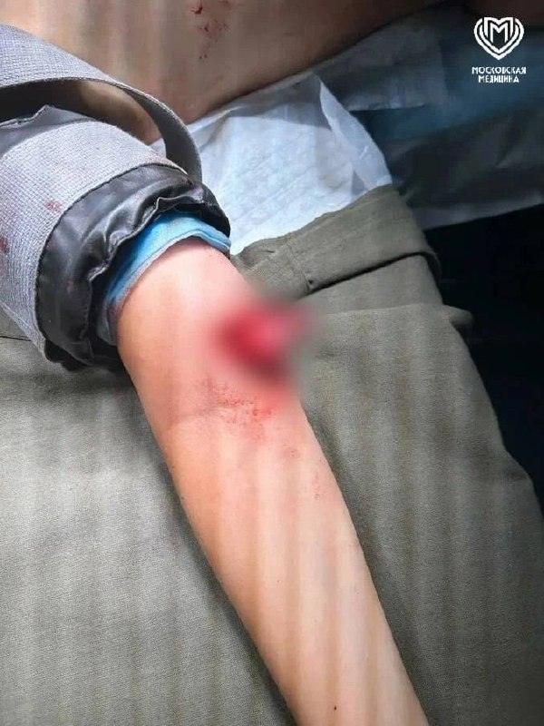 Врачи спасли руку 9-летнему мальчику после падения с питбайка 🏥⚡ — ребенок пострадал на питбайке новости