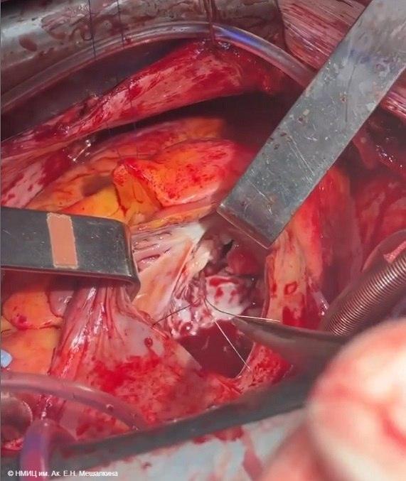 Врачи спасли сердце мотоциклиста от смертельных осколков 🫀⚡ — металлические иглы в сердце мотоциклиста новосибирск